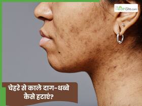 चेहरे से काले धब्बे कैसे साफ करें? जानें 5 तरीके, जो देंगे कमाल का निखार