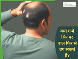 पेशेंट बोला 'मेरे परिवार में गंजेपन की कोई समस्या नहीं है', जानें क्या होता है बाल्ड स्पॉट और इसका पहचान कैसे करें