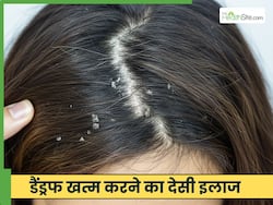सिर से झाड़ती रूसी को कैसे खत्म करें? जानें 5 तरीके, जो साफ कर देंगे स्कैल्प