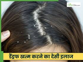सिर से झाड़ती रूसी को कैसे खत्म करें? जानें 5 तरीके, जो साफ कर देंगे स्कैल्प