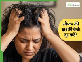 सिर में खुश्की हो जाए तो क्या करें? 5 उपाय देंगे साफ स्कैल्प, बालों को बनाएंगे हेल्दी