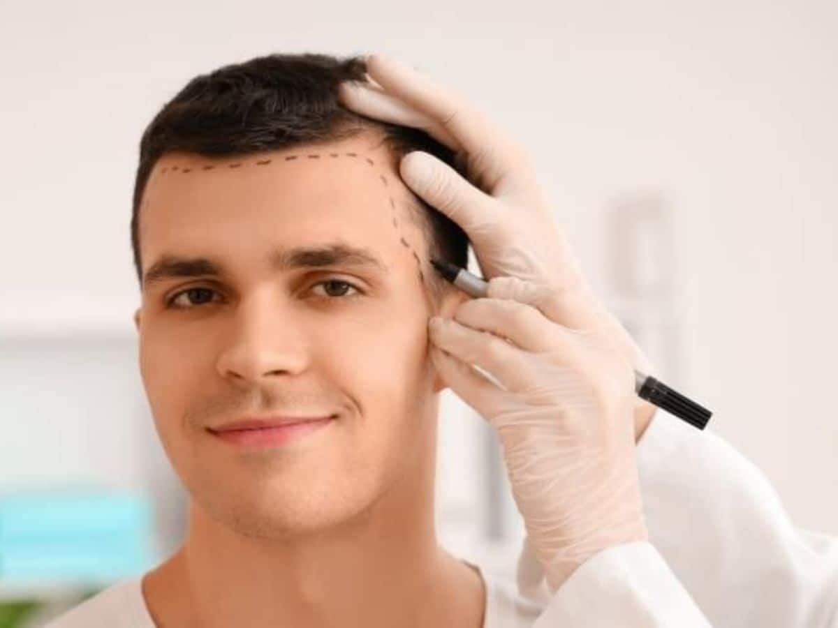 hair transplant7