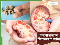 किडनी से पथरी निकाल फेंकते हैं ये 5 घरेलू नुस्खे, नहीं होता है कोई नुकसान
