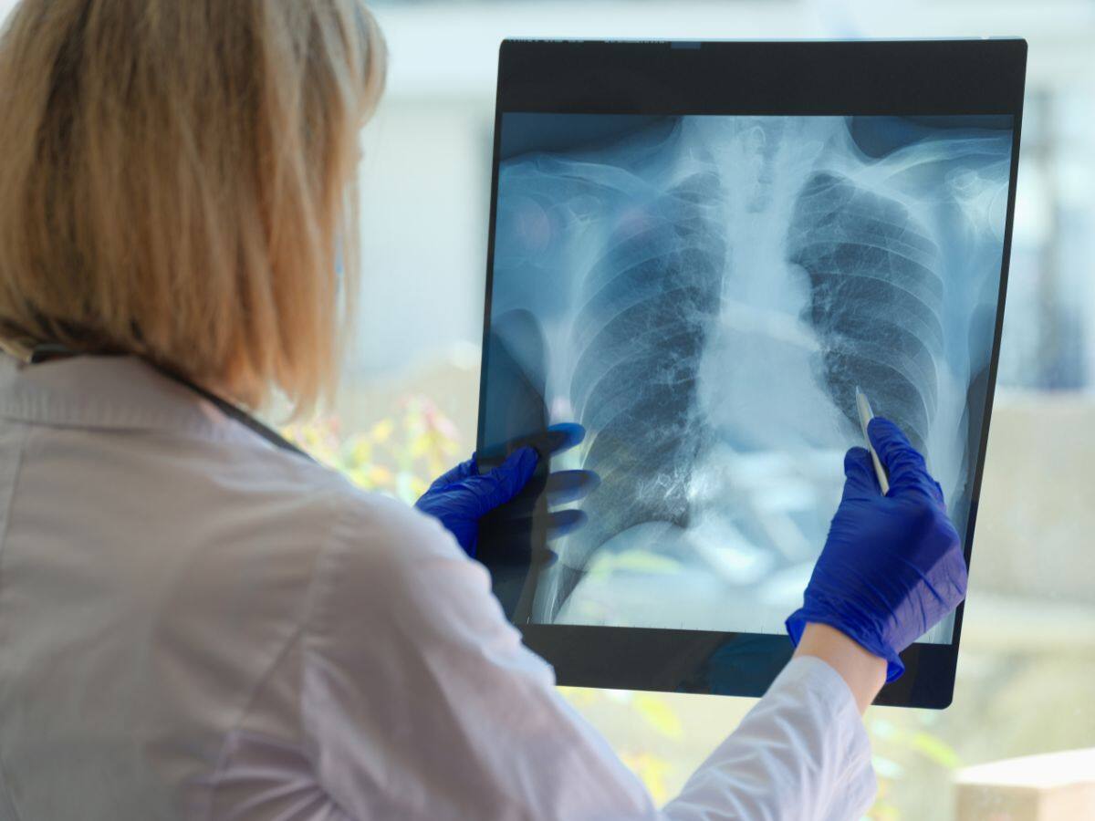 lung cancer 