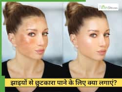 चेहरे की झाइयों को जड़ से खत्म कैसे करें? रोहित सचदेवा के बताए 2 नुस्खे मेलाज्मा से दिलाएंगे छुटकारा