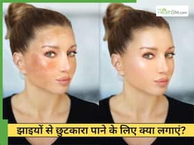 चेहरे की झाइयों को जड़ से खत्म कैसे करें? रोहित सचदेवा के बताए 2 नुस्खे मेलाज्मा से दिलाएंगे छुटकारा