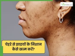 चेहरे की झाइयों को जड़ से खत्म कैसे करें? 5 घरेलू नुस्खे दिलाएंगे मेलाज्मा से छुटकारा