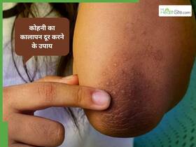 कोहनी का कालापन दूर करेगी किचन में रखी ये सफेद चीज, बस इस तरह से कर लें इस्तेमाल कोहनी का कालापन दूर करेगी किचन में रखी ये सफेद चीज, बस इस तरह से कर लें इस्तेमाल