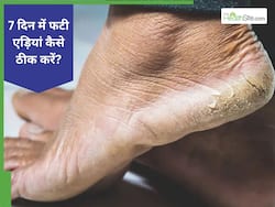 सर्दियों में 7 दिन में फटी एड़ियों को कैसे सॉफ्ट बनाएं?