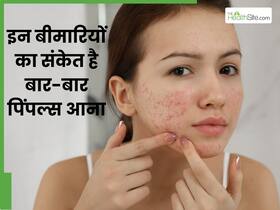 चेहरे पर बार-बार पिंपल्स निकलना सिर्फ स्किन प्रॉब्लम नहीं, शरीर इन 5 बीमारियों का भी देता है ये संकेत