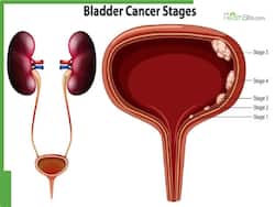 Childhood Virus Linked To Bladder Cancer: Signs And Prevention Tips