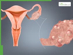 Expert Reveals PCOS Is A Lifestyle Disease; Urges Young Girls To Focus On Healthy Habits Early