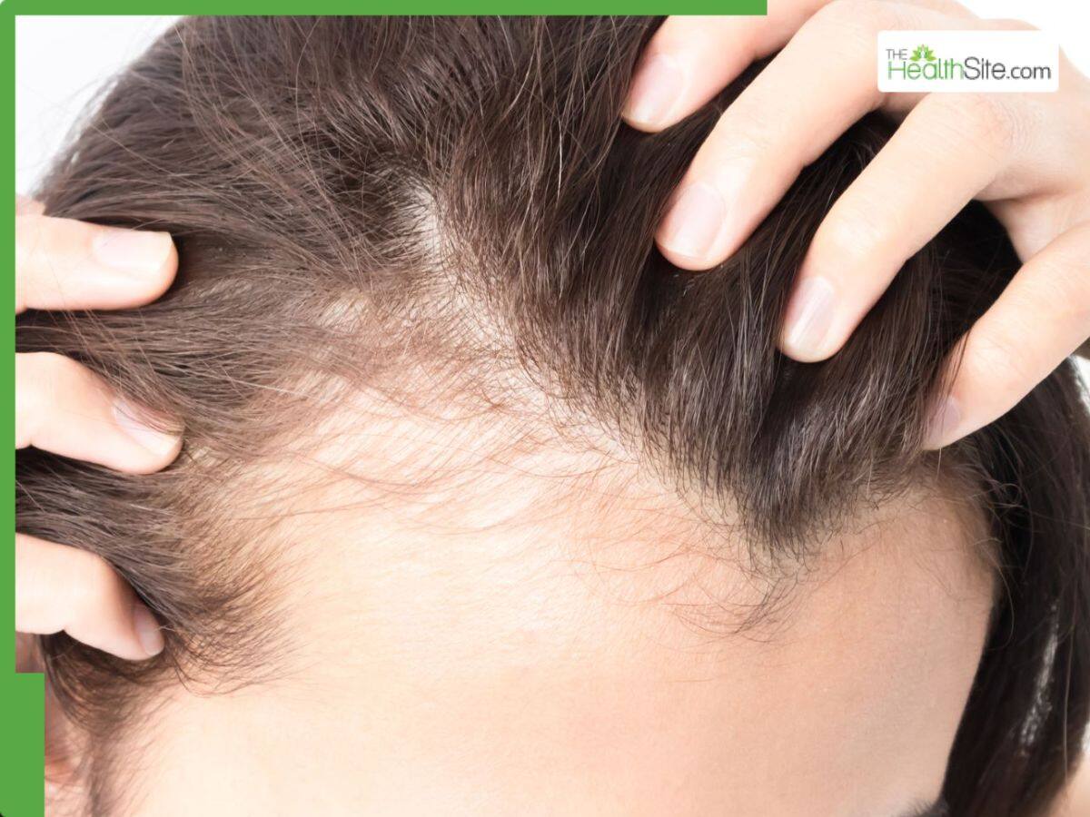 Hair Thinning or Excessive Hair Fall