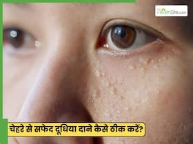 चेहरे से सफेद उभरे दाने हटाने के लिए क्या करें? करें ये 5 उपाय जो देंगे राहत