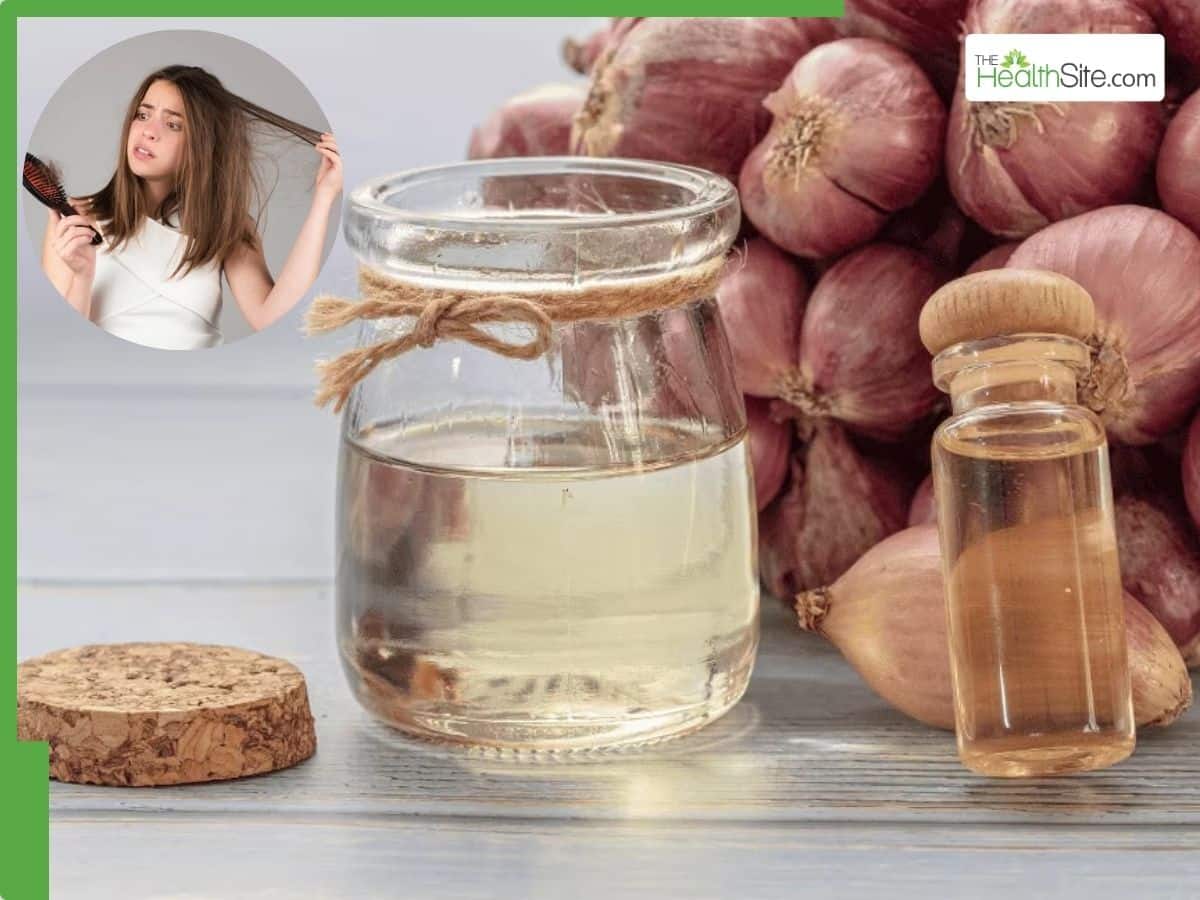 Onion Oil For Hair Growth: Can It Reduce Hair Fall And Regrow Hair Naturally?