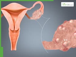 PCOD Warning Signs That Often Go Unnoticed: 5 Symptoms to Watch Out For