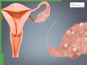 PCOD Warning Signs That Often Go Unnoticed: 5 Symptoms to Watch Out For PCOD Warning Signs That Often Go Unnoticed: 5 Symptoms to Watch Out For