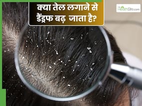 डैंड्रफ होने पर सिर पर लगा लेते हैं तेल तो जरा संभलकर, फायदे की जगह हो सकता है नुकसान