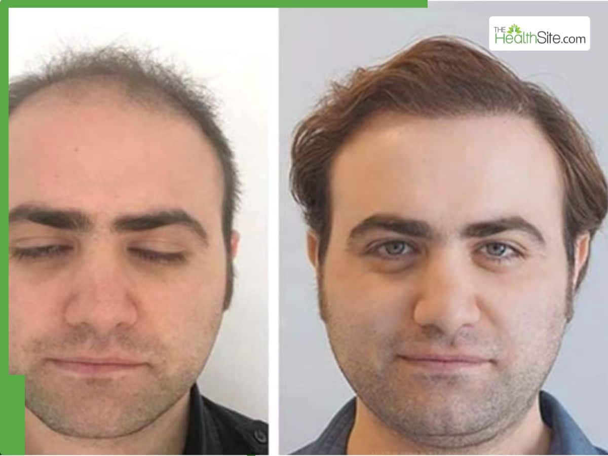 Top 10 Hair transplant clinics In Turkey: 2026 Guide And Prices |  The