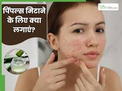 चेहरे के पिंपल्स से परेशान है तो लगाएं ये 1 चीज, दूर होगी समस्या और खिलेंगी त्वचा