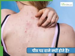 पीठ पर दाने क्यों होते हैं? जानें 3 आसान नुस्खे, जो बैक एक्ने से दिलाएंगे छुटकारा