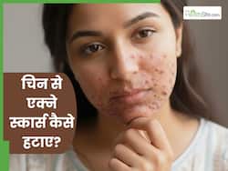 चिन पर होने वाले एक्ने स्कार्स को कैसे ठीक करें? जानें 5 तरीके जो खत्म करेंगे मुंहासों के निशान