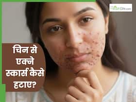 चिन पर होने वाले एक्ने स्कार्स को कैसे ठीक करें? जानें 5 तरीके जो खत्म करेंगे मुंहासों के निशान