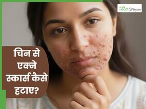 चिन पर होने वाले एक्ने स्कार्स को कैसे ठीक करें? जानें 5 तरीके जो खत्म करेंगे मुंहासों के निशान चिन पर होने वाले एक्ने स्कार्स को कैसे ठीक करें? जानें 5 तरीके जो खत्म करेंगे मुंहासों के निशान