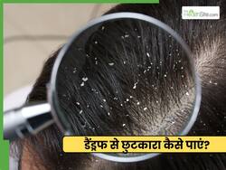 रूसी से छुटकारा कैसे पाएं? जानें 3 तरीके जो साफ करें स्कैल्प
