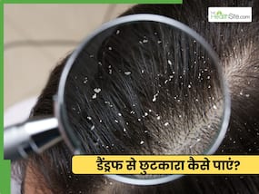 रूसी से छुटकारा कैसे पाएं? जानें 3 तरीके जो साफ करें स्कैल्प
