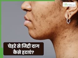 चेहरे से जिद्दी दाग कैसे हटाएं? जानें 5 तरीके जो दूर करेंगे हर स्किन प्रॉब्लम