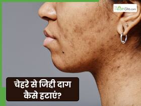 चेहरे से जिद्दी दाग कैसे हटाएं? जानें 5 तरीके जो दूर करेंगे हर स्किन प्रॉब्लम