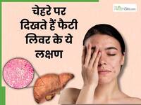 चेहरे पर दिखने वाले ये 4 लक्षण हो सकते हैं फैटी लिवर के लक्षण, ड्रिंक करने वाले जरूर दें ध्यान