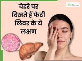 चेहरे पर दिखने वाले ये 4 लक्षण हो सकते हैं फैटी लिवर के लक्षण, ड्रिंक करने वाले जरूर दें ध्यान चेहरे पर दिखने वाले ये 4 लक्षण हो सकते हैं फैटी लिवर के लक्षण, ड्रिंक करने वाले जरूर दें ध्यान