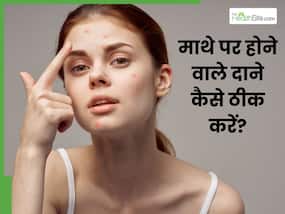 माथे पर आने वाले दानों को कैसे ठीक करें? जानें 5 तरीके जो ठीक करेंगे समस्या