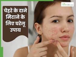 चेहरे के दाने मिटाने के लिए लगाएं ये 5 घरेलू उपाय, जिनसे रिमूव हो जाएंगे सारे मुंहासे और दाग-धब्बे