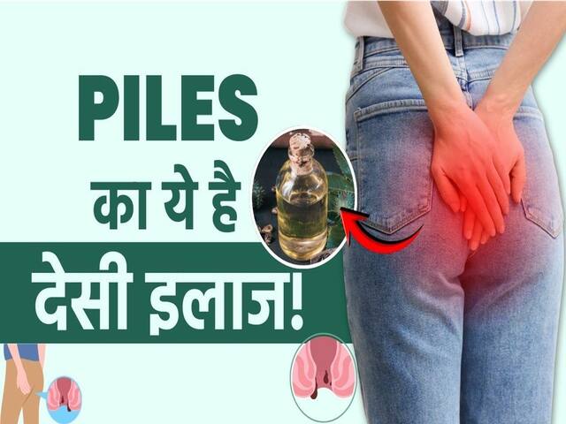 बवासीर का इलाज बिना ऑपरेशन के, जानें क्या करें?