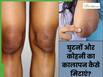 सर्दियों में घुटनों और कोहनी का कालापन कैसे हटाएं? जानें 5 घरेलू उपाय