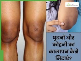 सर्दियों में घुटनों और कोहनी का कालापन कैसे हटाएं? जानें 5 घरेलू उपाय सर्दियों में घुटनों और कोहनी का कालापन कैसे हटाएं? जानें 5 घरेलू उपाय