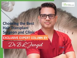 Choosing the Best Hair Transplant Surgeon and Clinic: 6 Expert Tips You Must Know