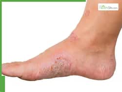Expert Reveals What Causes Dry Feet In Diabetes: Symptoms, Risks, And Care Tips
