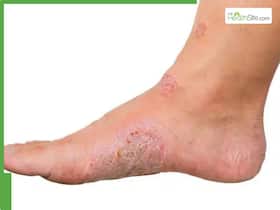 Expert Reveals What Causes Dry Feet In Diabetes: Symptoms, Risks, And Care Tips