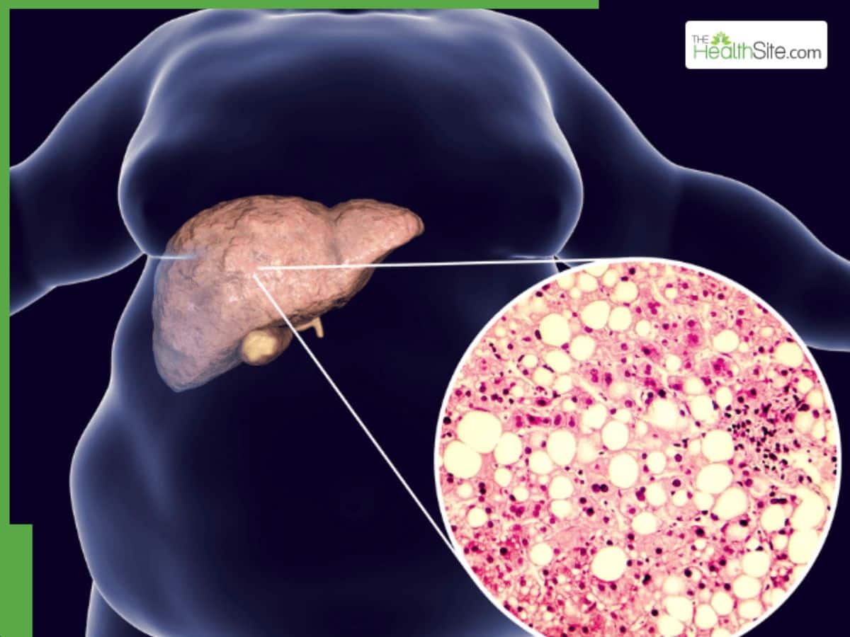 Diabetes Significantly Increases Liver Damage Risk in India, Study Reveals | Quick Digest