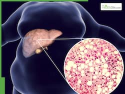 Fatty Liver On Rise In India: Why Young Adults Are Now At Risk Of This Lifestyle Disease