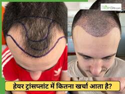 जानें हेयर ट्रांसप्लांट क्या होता है? इसमें कितना खर्चा आता है और बाल कितने समय में उग जाते हैं?