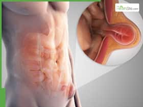 Hernia Symptoms: Early Warning Signs of a Small Bulge You Shouldn   t Ignore