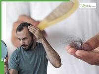 Male Alopecia Treatment: Hair Loss Is Progressive But Preventable - How To Manage Baldness Before Its Too Late