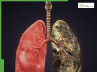 Non-Smokers At Risk: Why Lung Cancer Cases Are Increasing Among People Who Never Smoked