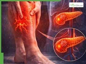 Pancreatic Cancer in India: 35,000   40,000 New Cases Annually and 90% Die Within 5 Years - Is Leg Pain the First Deadly Sign?