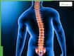 Scoliosis Is Not Just Bad Posture: Doctor Explains Types, Risks And Treatment Options